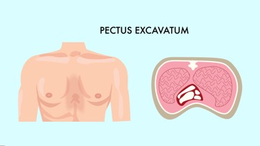 Lõm ngực bẩm sinh là gì? Những vấn đề cần biết về lõm ngực bẩm sinh