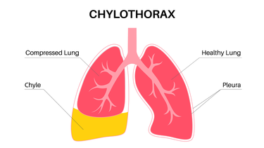 Màng phổi là gì? Vị trí, chức năng và các bệnh thường gặp