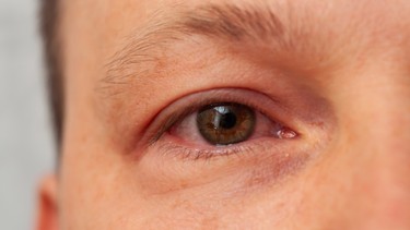 Mắt đỏ là dấu hiệu bệnh gì? Cách xử trí hiệu quả khi gặp phải