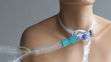 Mở khí quản là gì? Những thông tin cơ bản về kỹ thuật mở khí quản