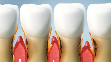 Mòn cổ chân răng là gì? Những điều cần biết về mòn cổ chân răng