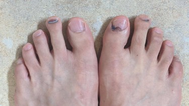 Móng chân bị đen do nguyên nhân gì? Cách xử lý khi móng bị đen