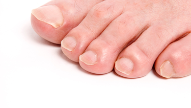 Móng chân có sọc đen là gì? Cảnh báo sức khỏe không nên bỏ qua