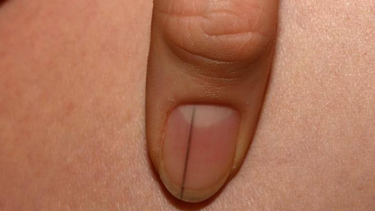 Móng tay bị sọc đen là gì? Dấu hiệu cảnh báo gì cho sức khỏe?