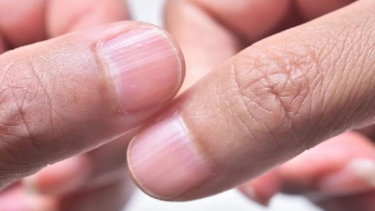 Móng tay bị sọc là gì? Nguyên nhân và cách chăm sóc đúng cách