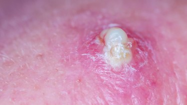 Mủ là gì? Nguyên nhân, triệu chứng và cách xử lý hiệu quả