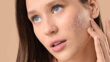 Mụn ẩn dưới da là gì? Nguyên nhân và cách xử lý hiệu quả