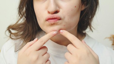 Mụn bọc ở cằm: Tín hiệu từ bên trong cơ thể bạn không nên bỏ qua