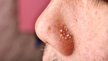 Mụn đầu trắng: Nguyên nhân và cách xử lý đúng cách