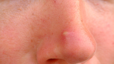 Mụn đinh râu có nguy hiểm không? Cách nhận biết và xử lý đúng cách