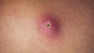 Mụn đinh râu có nguy hiểm không? Cách nhận biết và xử lý đúng cách