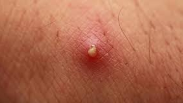 Mụn đinh râu kiêng ăn gì để hỗ trợ điều trị hiệu quả?