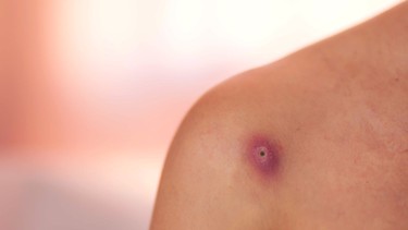 Mụn đinh râu là gì? Nguyên nhân, dấu hiệu và cách phòng ngừa hiệu quả