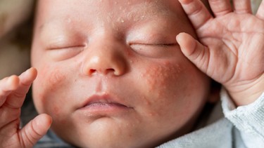 Mụn kê ở trẻ sơ sinh: Nguyên nhân, dấu hiệu và cách chăm sóc an toàn