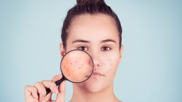 Mụn nội tiết là gì? Nguyên nhân, triệu chứng và cách điều trị hiệu quả