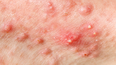 Mụn ở nách: Nguyên nhân, cách xử lý an toàn và phòng ngừa tái phát