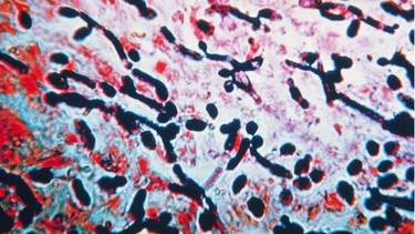 Nấm Candida có lây không? Cách phòng ngừa hiệu quả