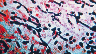 Nhiễm nấm Candida: Triệu chứng, nguyên nhân, chẩn đoán, điều trị và phòng ngừa