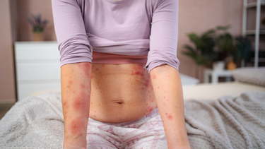 Nguyên nhân tay chân bị nổi chấm đỏ ngứa