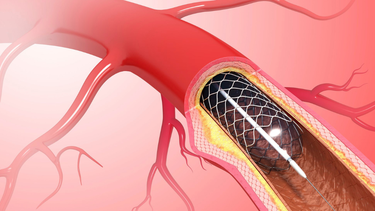 Người đặt stent mạch vành sống được bao lâu? Các yếu tố quyết định tuổi thọ
