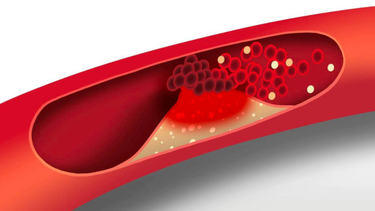 Người mắc bệnh mỡ máu cao có ăn được thịt bò không?