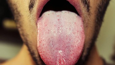 Nguyên nhân bị nấm lưỡi ở người lớn? Triệu chứng và biện pháp phòng ngừa