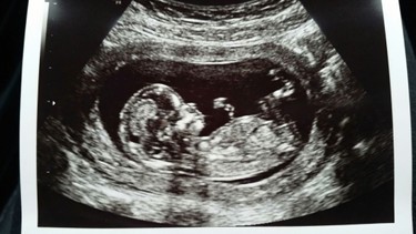 Nguyên nhân thai không quay đầu và hướng xử lý an toàn