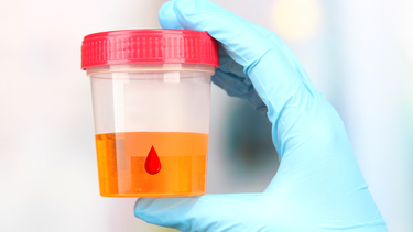 Nguyên nhân và cách điều trị đi tiểu ra máu nhưng không đau​