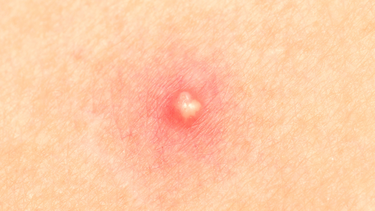 Nhận biết các loại mụn ở mông và cách chăm sóc hiệu quả