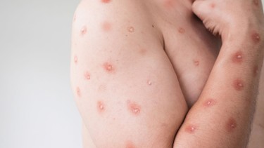 Nhận biết dấu hiệu bệnh đậu mùa khỉ