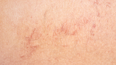 Nhận biết giãn mao mạch mặt như thế nào?