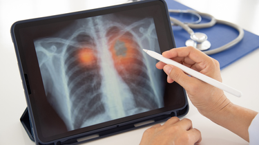 Nhận biết u phổi lành tính: Triệu chứng thường gặp