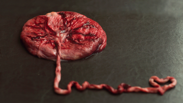 Nhau bong non có nguy hiểm không? Thông tin cần biết cho mẹ bầu