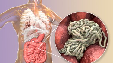Nhiễm giun kim: Nguyên nhân, triệu chứng và cách phòng ngừa