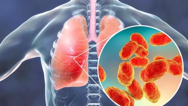 Nhiễm nấm Histoplasma: Triệu chứng, mức độ nguy hiểm và cách điều trị