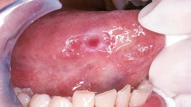 Nhiệt miệng ở lưỡi do nguyên nhân gì? Cách khắc phục hiệu quả