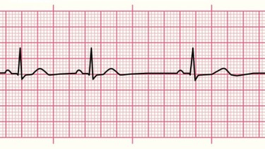 Nhịp xoang là gì? Nguyên nhân gây nhịp xoang nhanh, chậm và cách xử lý