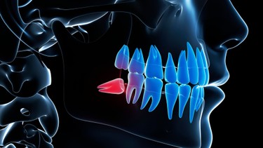 Nhổ răng khôn có nguy hiểm không? Mức độ rủi ro và những điều cần biết trước khi nhổ