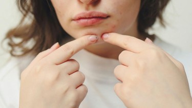 Những cách trị mụn nội tiết ở cằm​ đơn giản, dễ thực hiện
