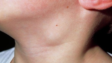 Nổi hạch ở cổ bên trái là gì? Nguyên nhân và cách xử lý