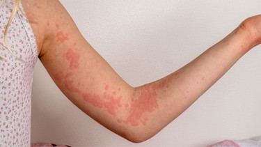 Nổi mề đay ban đêm: Nguyên nhân, cách xử lý và phòng ngừa hiệu quả