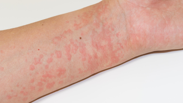 Nổi mề đay có được ra gió không? Vì sao gió có thể khiến mề đay nặng hơn?