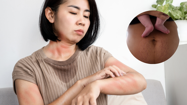 Nổi mề đay sau sinh: Nguyên nhân, dấu hiệu và cách xử lý an toàn