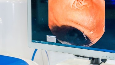 Nội soi thực quản: Khi nào cần thực hiện và có đau không?