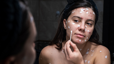 Nốt thủy đậu màu trắng đục là hiện tượng gì? Cách điều trị đúng