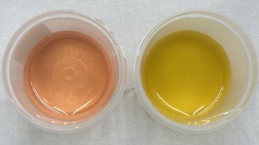 Nước tiểu màu hồng nhạt ở trẻ em: Cảnh báo bệnh lý, cha mẹ chớ chủ quan!