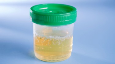 Nước tiểu màu trắng đục: Nguyên nhân, mức độ nguy hiểm và cách khắc phục