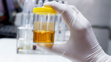 Nước tiểu vàng như nước chè: Nguyên nhân, mức độ nguy hiểm và cách khắc phục