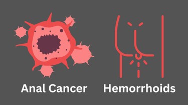 Phân biệt ung thư hậu môn và trĩ: Dấu hiệu nhận biết và mức độ nguy hiểm