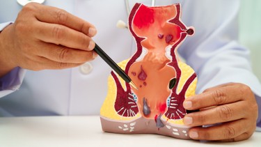 Phân độ trĩ: Nhận biết các cấp độ và cách điều trị phù hợp